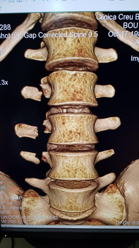 toni-bou-fractura-vertebras2